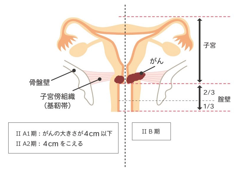 子宮体がんの進行期 Ⅲ期