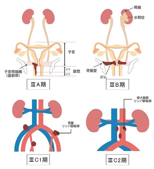 子宮体がんの進行期 Ⅲ期