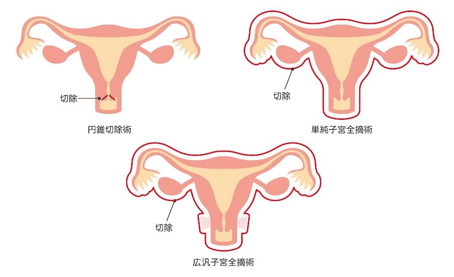 子宮頚がん手術の術式