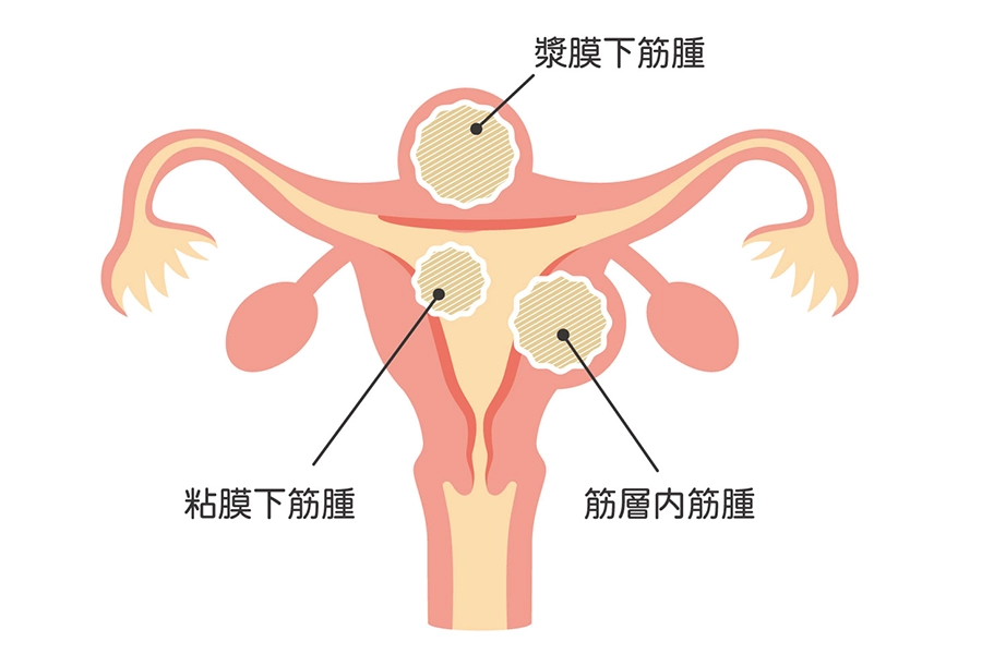 子宮筋腫の症状