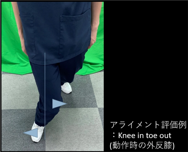 膝蓋骨脱臼のリハビリテーション