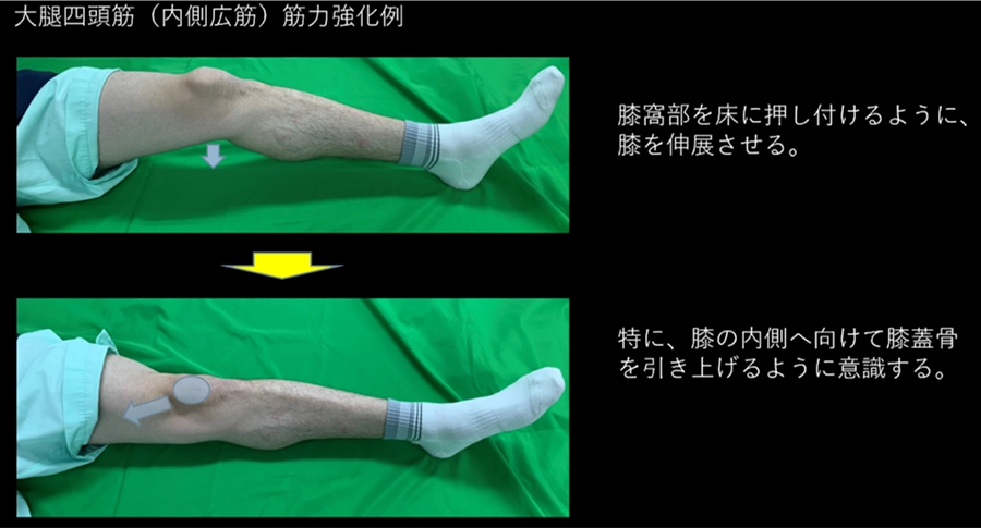 膝蓋骨脱臼のリハビリテーション