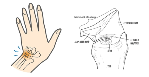 TFCC損傷の症状と構造