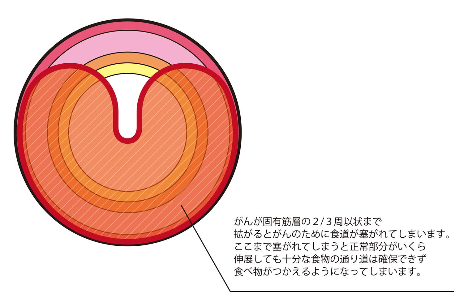 食道がん 外科の主な疾患と治療方法 江戸川病院